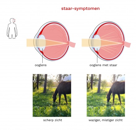 Staar (Cataract) - Oorzaken & Symptomen - Bergman Clinics | Ogen